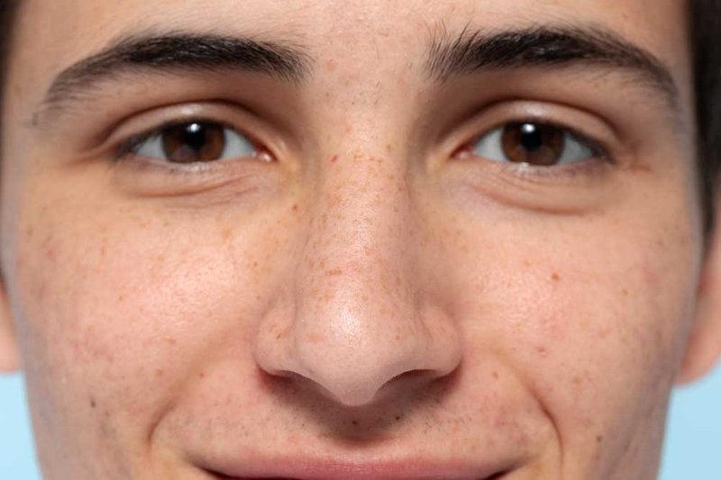 Desafiando los Poros Abiertos